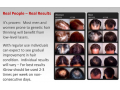 igrow-laser-hair-growth-system-revolutionary-non-surgical-way-to-regrow-hair-small-2